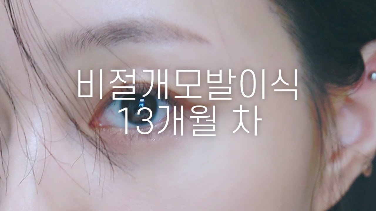 나 기다렸어?😈 비절개모발이식 13개월차 후기