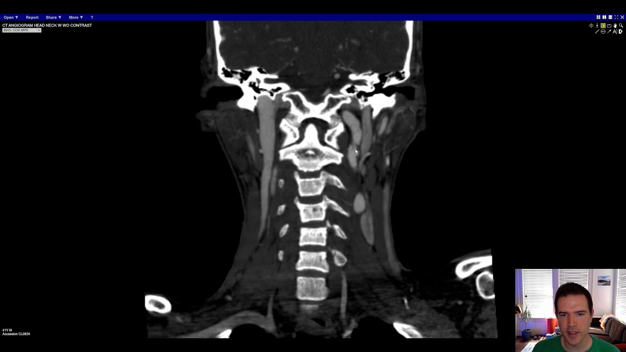 Vascular Imaging of the Head and Neck - Case D