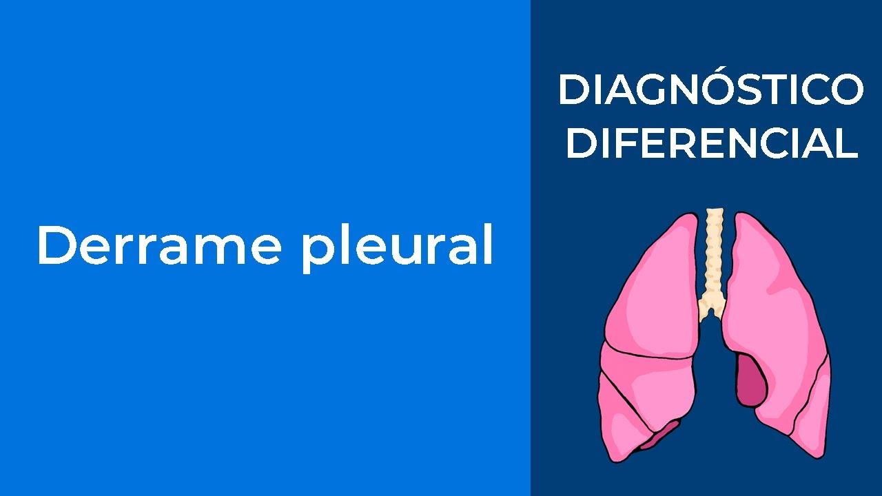 Diagnóstico Diferencial. Derrame pleural