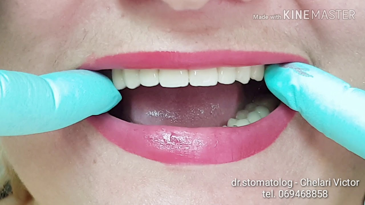 Stomatologie Chisinau, Botanica - TerraDent, Moldova!  Sunt dinti ficsi. Au o duritate maxima.