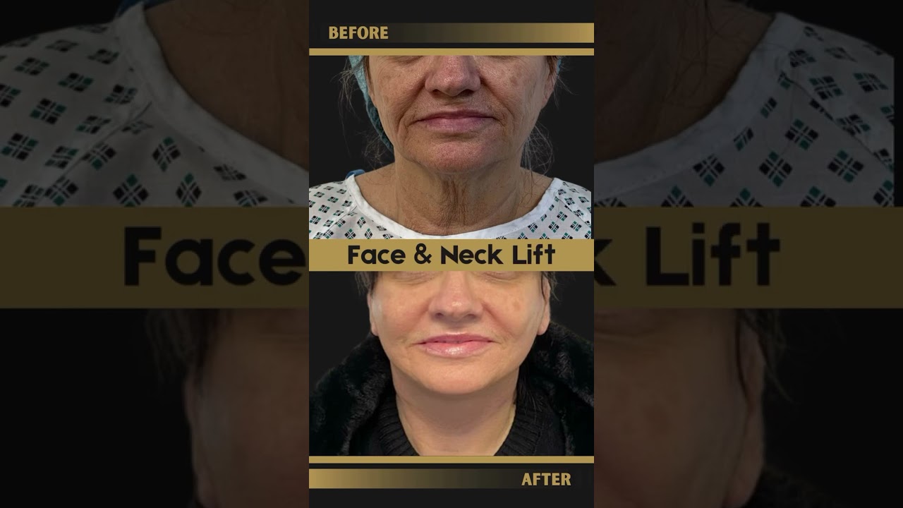 Refined contours Balanced definition Face & neck lift results designed to look natural and age