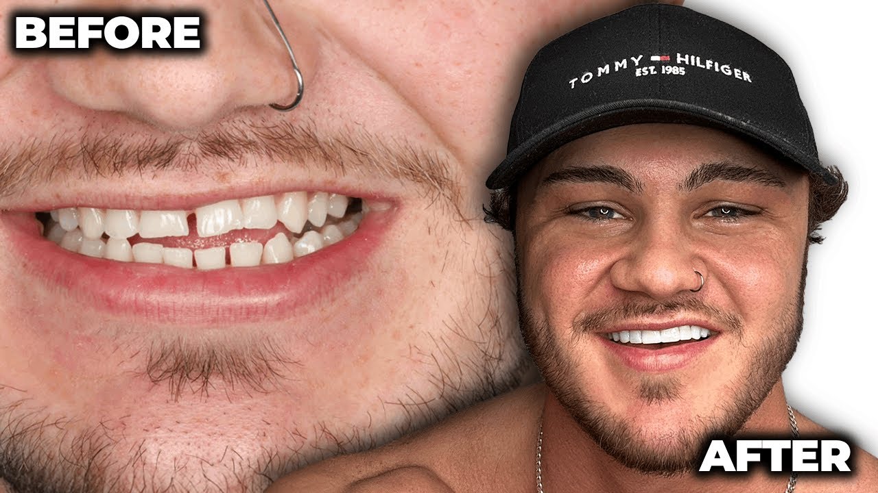 Getting Australias CHEAPEST VENEERS (Changed my life forever)