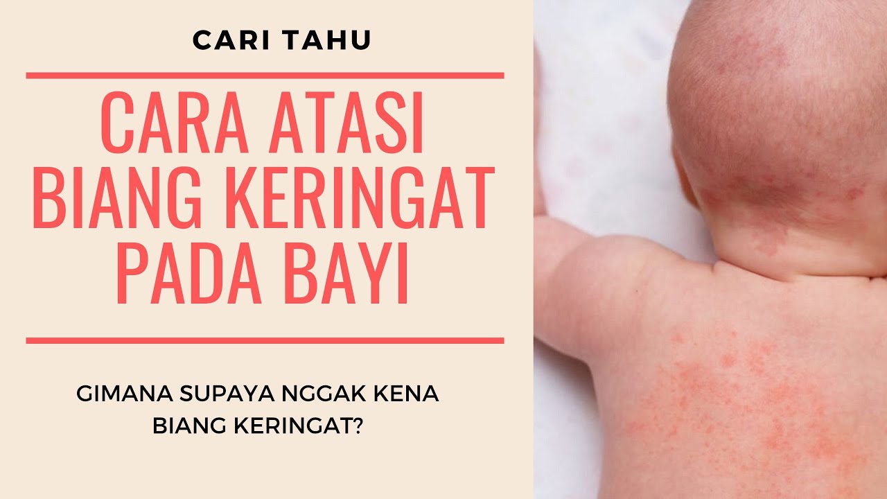 Cara Mengatasi Biang Keringat/Keringet Buntet Pada Bayi