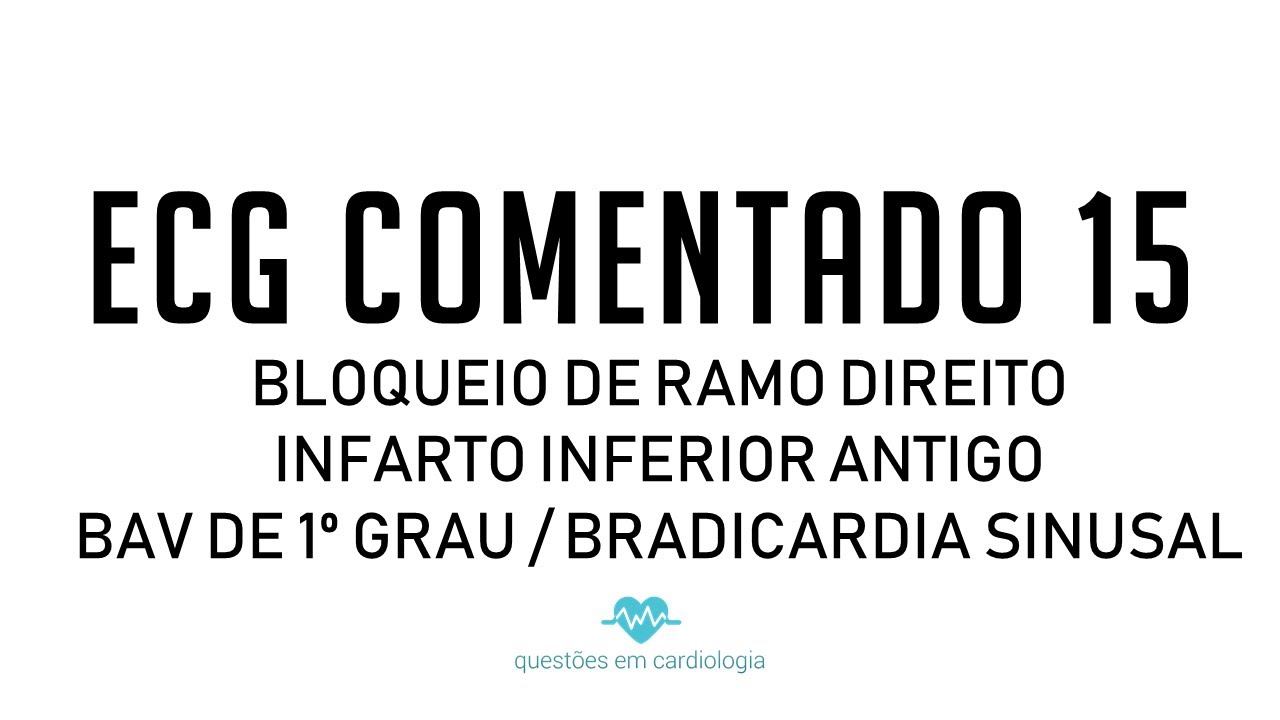 ECG Comentado 15 - Bloqueio de Ramo Direito / Infarto inferior antigo / BAV primeiro grau