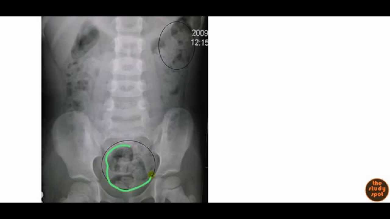 Constipation for USMLE