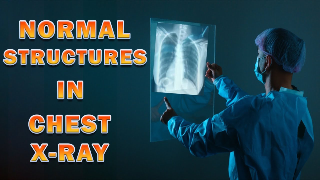 Chest X-Ray - 02 -  Normal Structures & Landmarks in Chest X-Ray