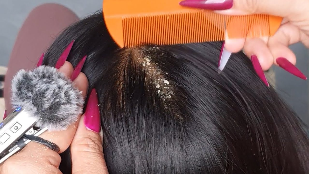 Ultimate Scalp Tingle Care ASMR 💆&zwj;♀️✨ | Heavy Flakes, Gentle Scratching & Sleep Calm #DN0567
