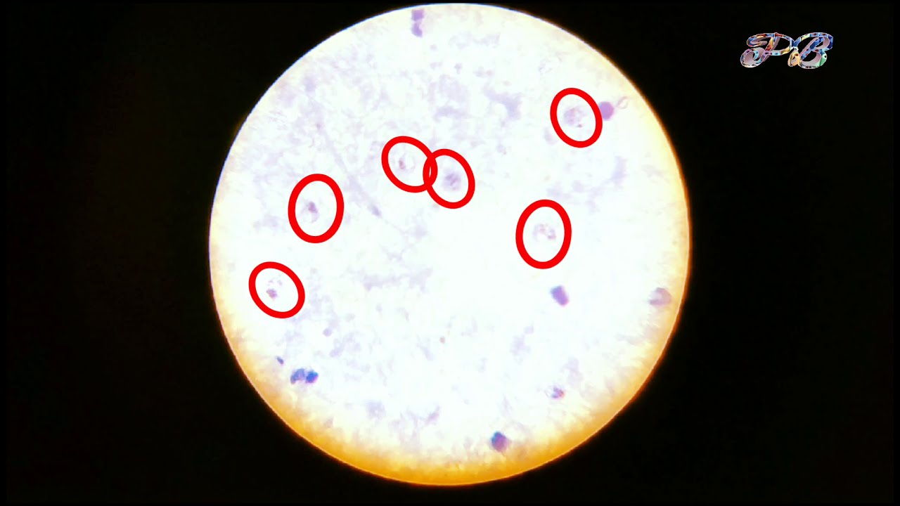 Malaria  || malaria test || types of malaria || Plasmodium || mp slides