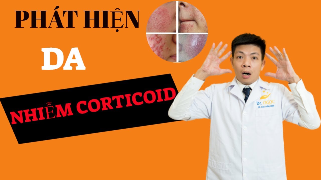 Phát hiện da nhiễm Corticoid bằng cách nào/DR.NGỌC