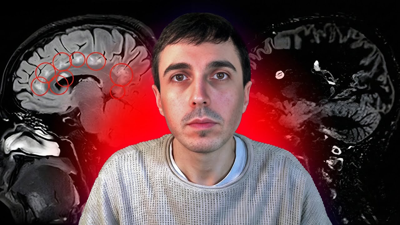 SCLEROSI MULTIPLA: La mia storia. Testimonianza e sintomi, come l'ho scoperta e la affronto.