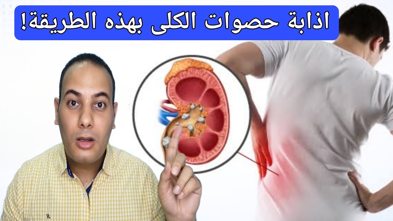 اذابة وتفتيت حصوات الكلى بعد تطبيق هذه الطريقة الناجحه/علاج حصوات الكلى بدون جراحة!