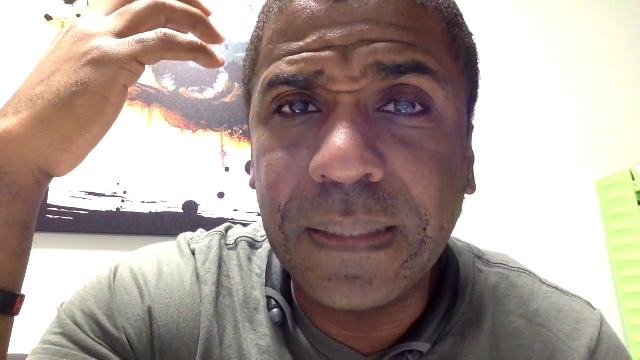 Patient with post-LASIK ectasia and a corneal transplant.