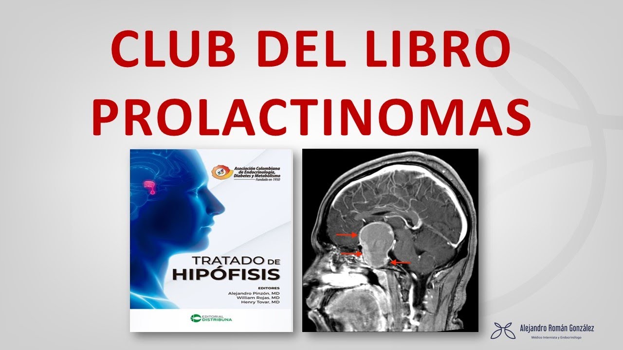 Club del libro: Prolactinomas. Bonus Track (Approach to the Patient with Prolactinoma JCEM 2023)