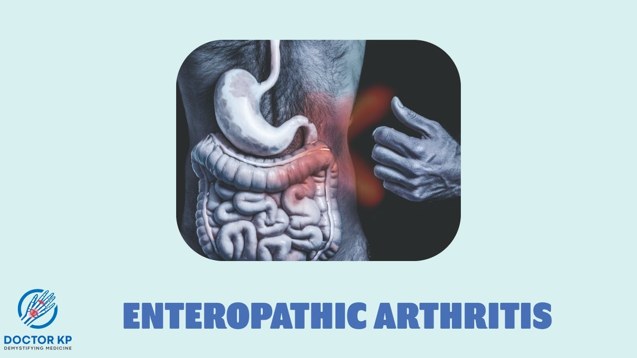 Enteropathic arthritis
