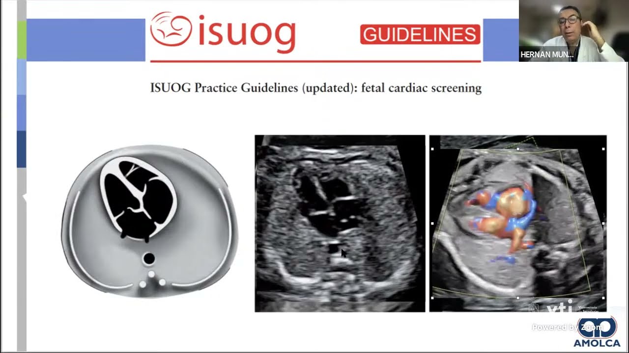 Ecocardiografía Fetal (25 Jornada MMF HCUCH 2023)