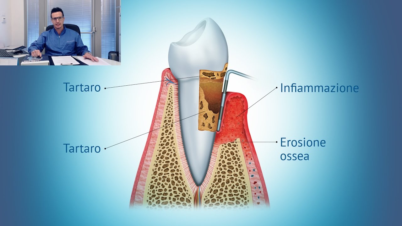 Dr. Andrea Pavanetto - La piorrea si può prevenire e curare?