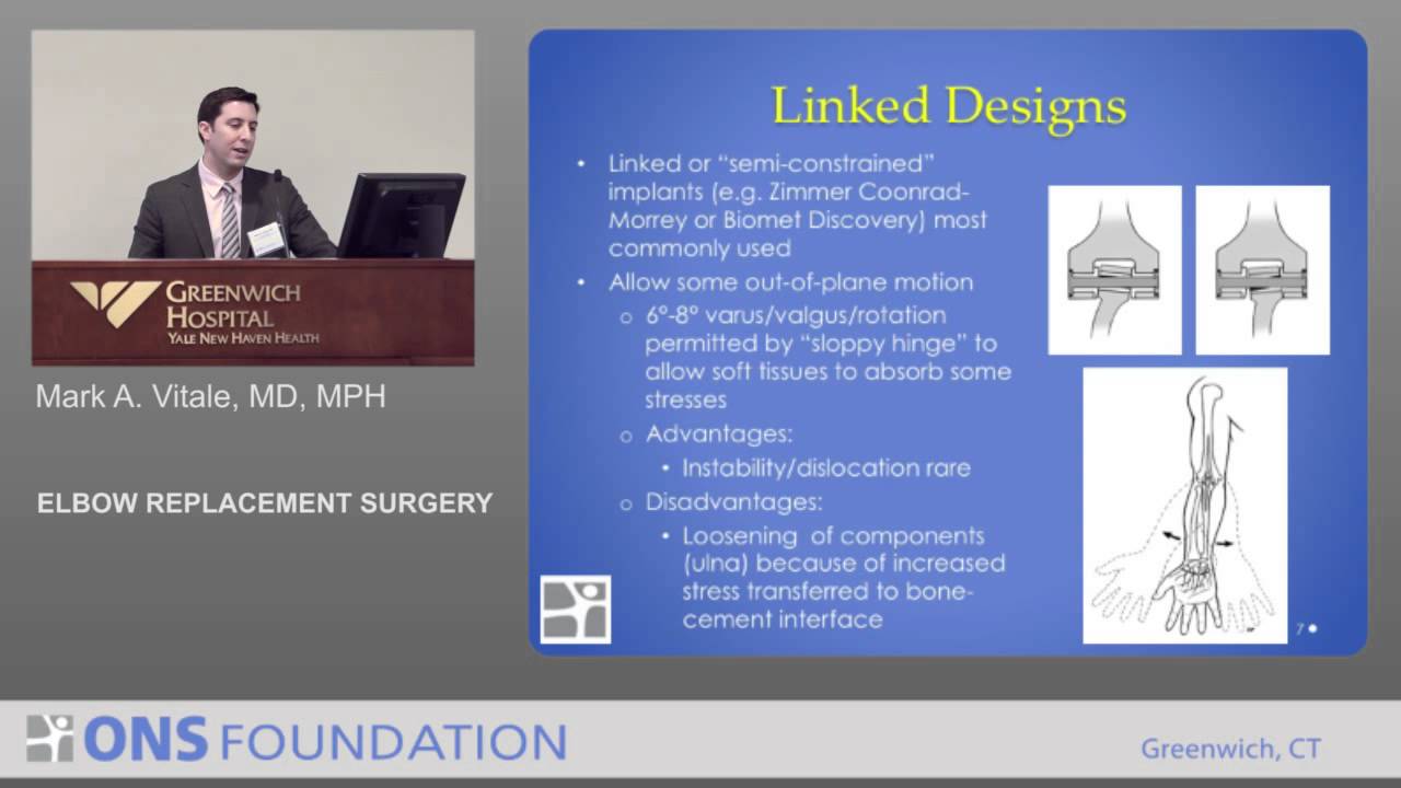 Elbow Replacement Surgery by orthopaedic surgeon Mark Vitale, MD