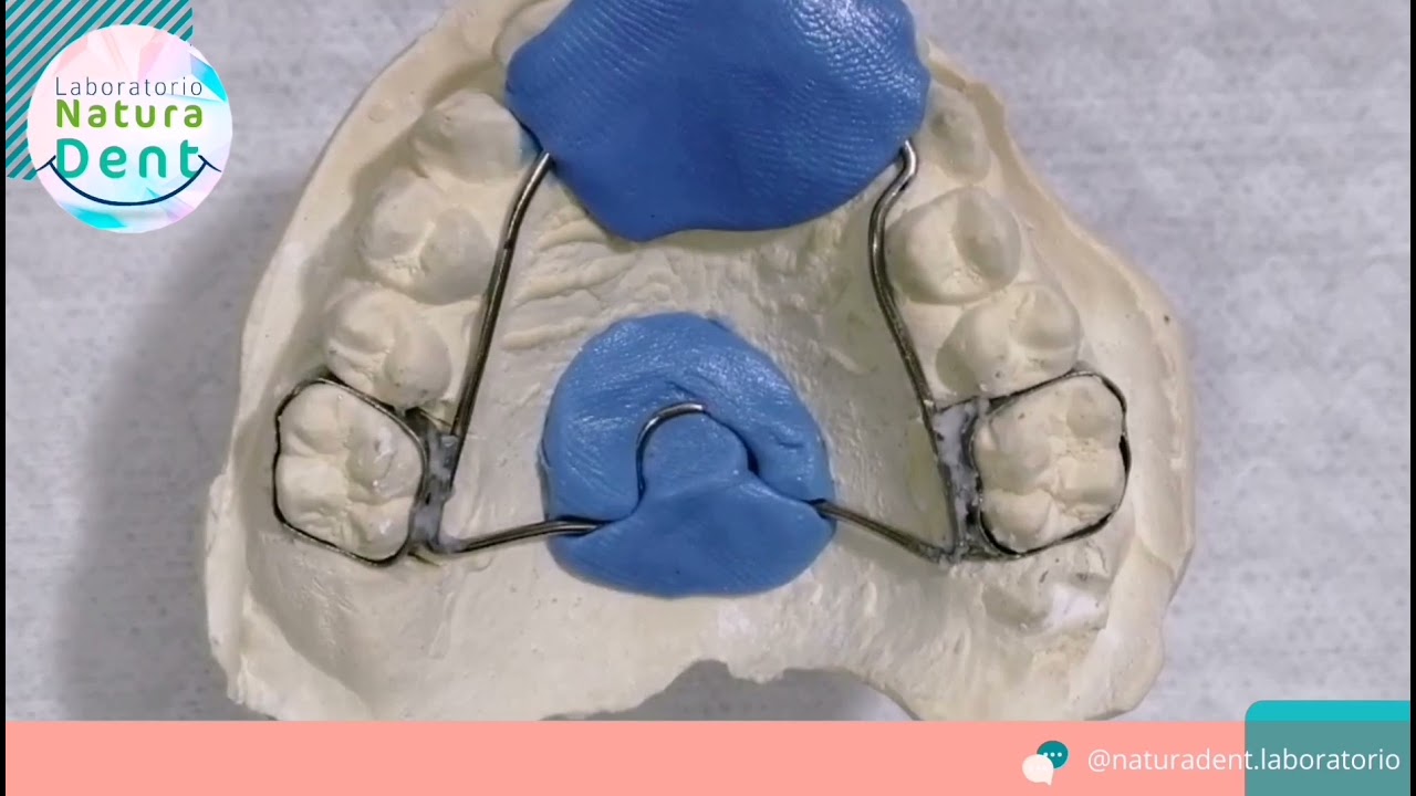Puntos de soldadura en aparatología fija - Laboratorio Dental -
