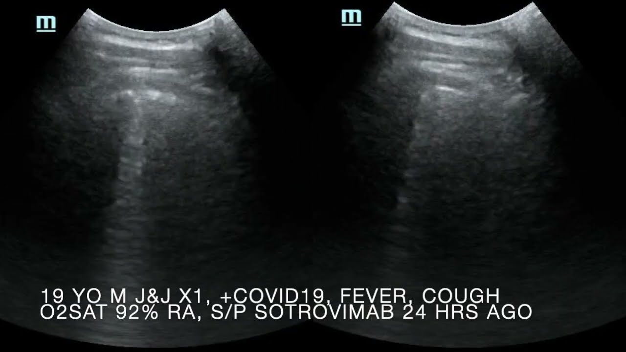 Omicron Covid-19 Pneumonia