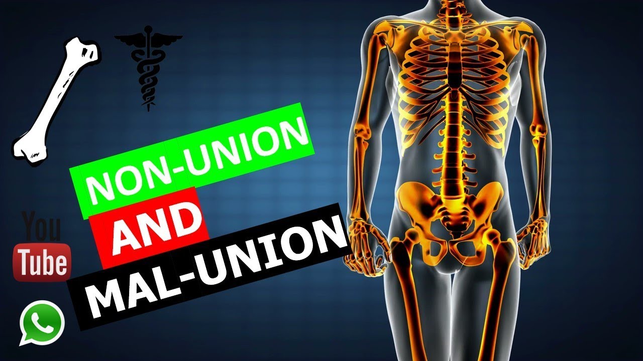 Orthopedics - NON-UNION & MAL-UNION  |FMGE/NEET-PG|