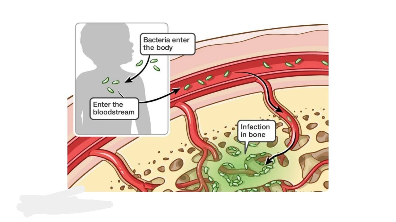 How bone infection lead to necrosis Death of Tissues