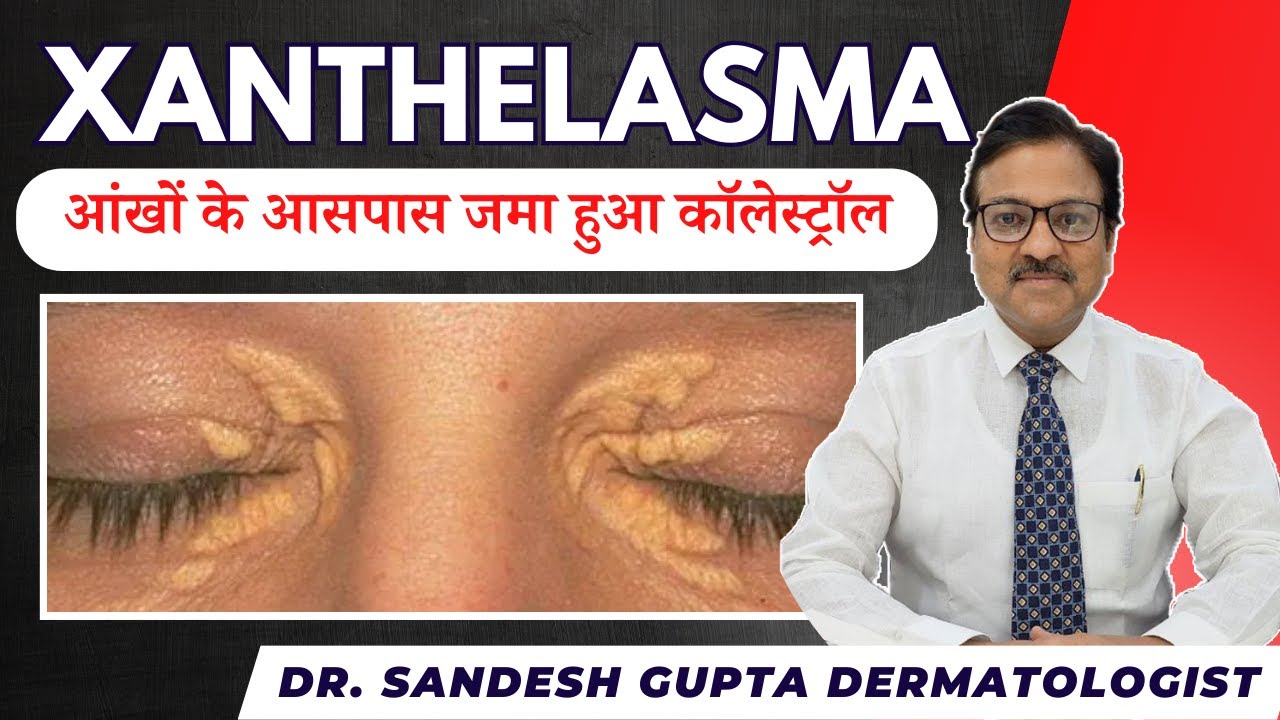 पलकों में ज़मी चर्बी Xanthelasma Palpebrum को कैसे हटाये। Skin n laser Centre Delhi. 9990804085