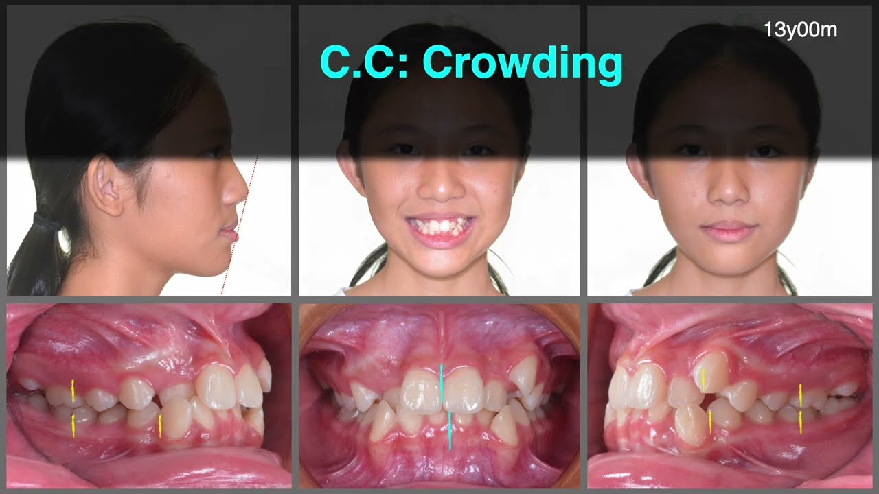 Treatment of Supernumerary Teeth and Crowding｜【Chris Chang Ortho】CC776