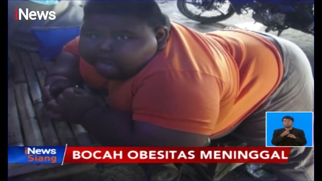 Satya Putra, Bocah Obesitas Berbobot 100 Kg Meninggal Setelah Alami Sesak Napas - iNews Siang 30/09