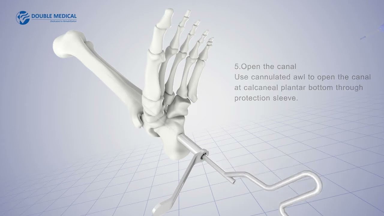Clavo De Artrodesis De Tobillo (AAN) - Double Medical