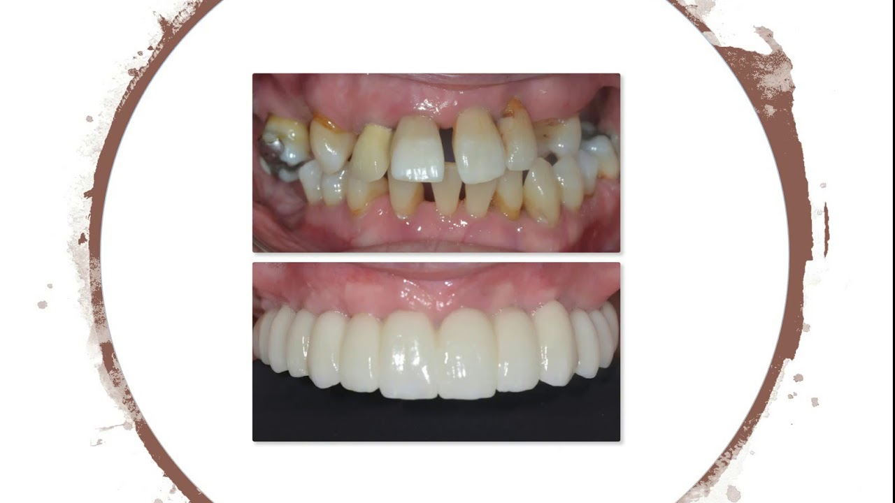 Full arch replacement teeth options explained by Dr Mohsin Patel