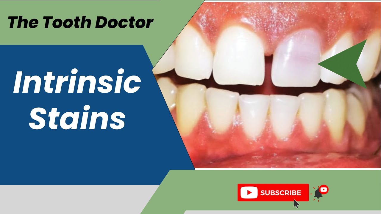 INTRINSIC STAINS || THE TOOTH DOCTOR