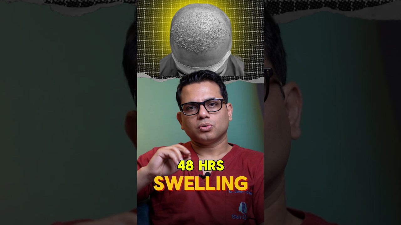 When does swelling go away after a hair transplant? | Hair Transplant QnA Session by Dr Jangid