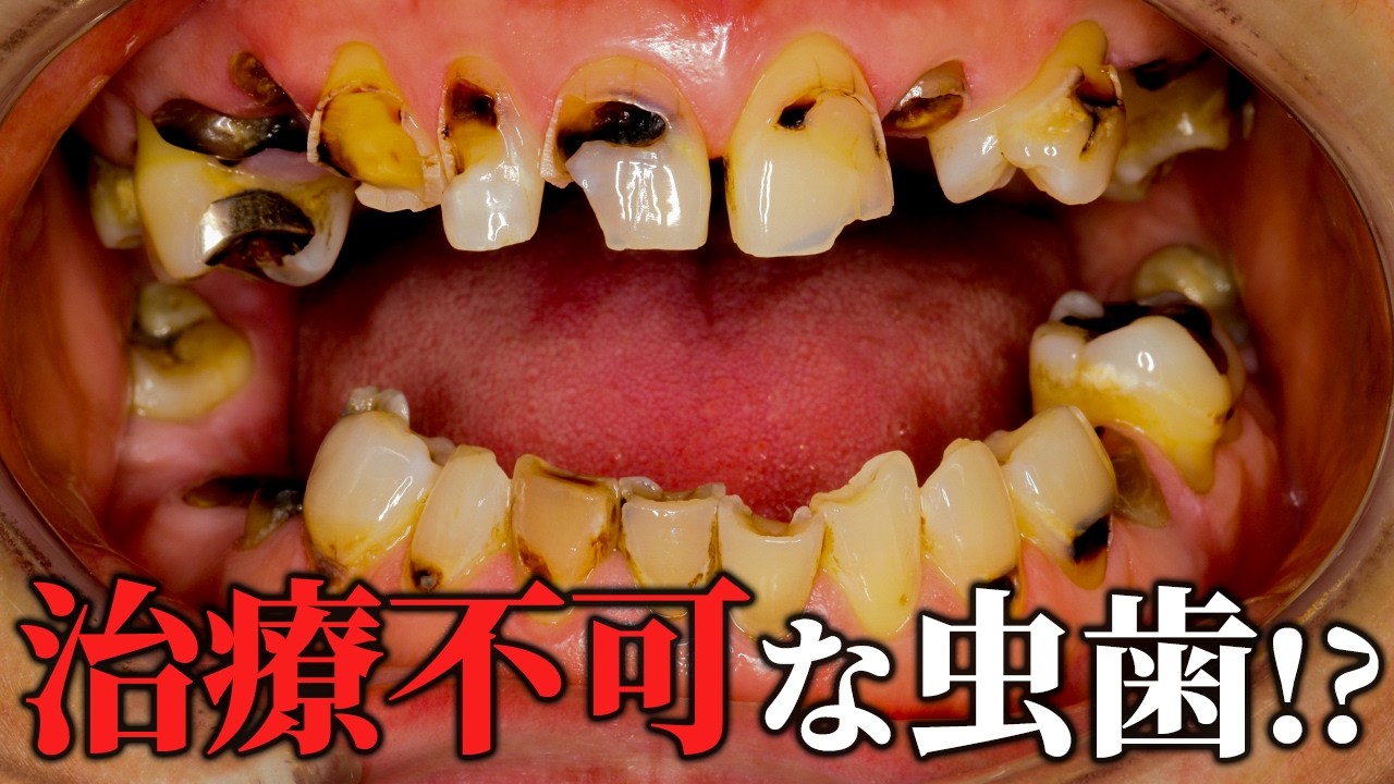 【99％の歯医者が治療を戸惑う】悪魔的症例に立ち向かえ