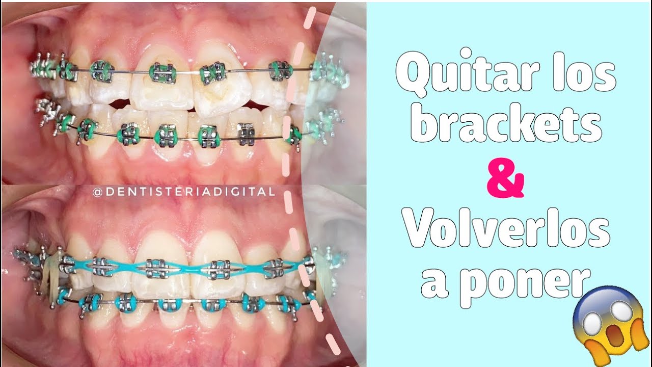 QUITAR LOS BRACKETS Y VOLVERLOS A PONER  -  REUBICACI&Oacute;N DE BRACKETS!