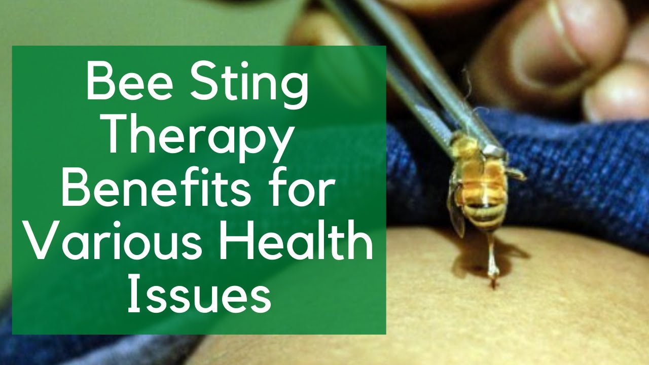 Bee Sting Therapy Benefits for Various Health Issues