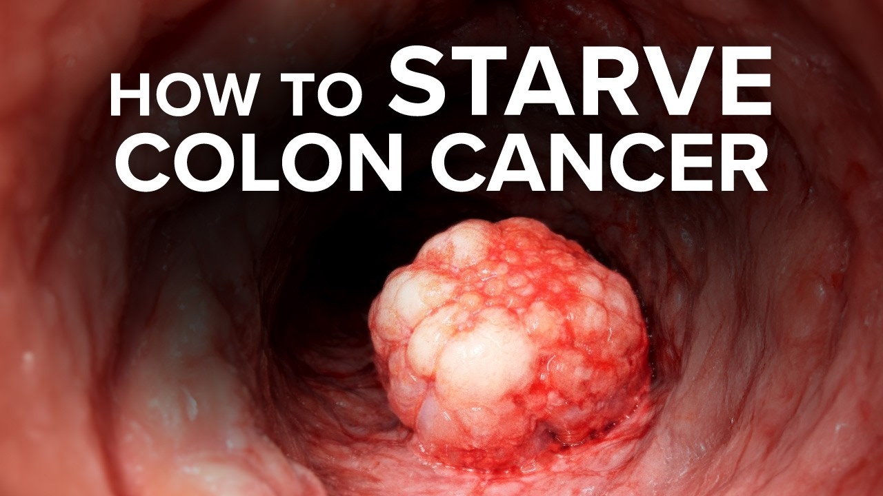 Advanced-Stage Colon Cancer Dies When You Do THIS (Scientific Proof)