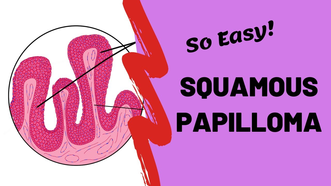 Squamous Papilloma | Oral Pathology Lectures