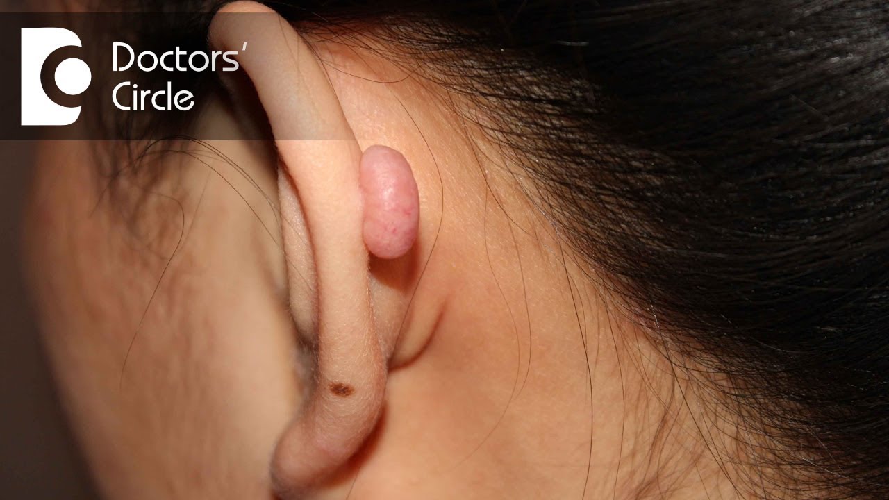 What do bumps on cartilage after Ear Piercing signify? - Dr. Harihara Murthy