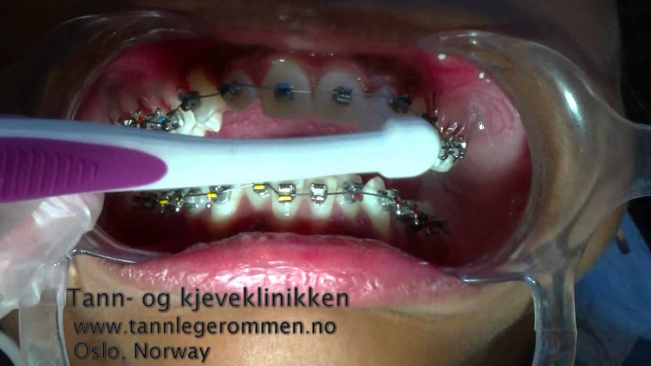 Tannpuss og tannregulering ved tann- og kjeveklinikken. Tannregulering rommen. Tannleger rommen