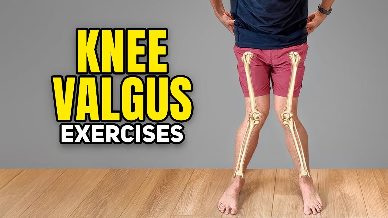 Knock Knee Exercises (Knee Valgus)