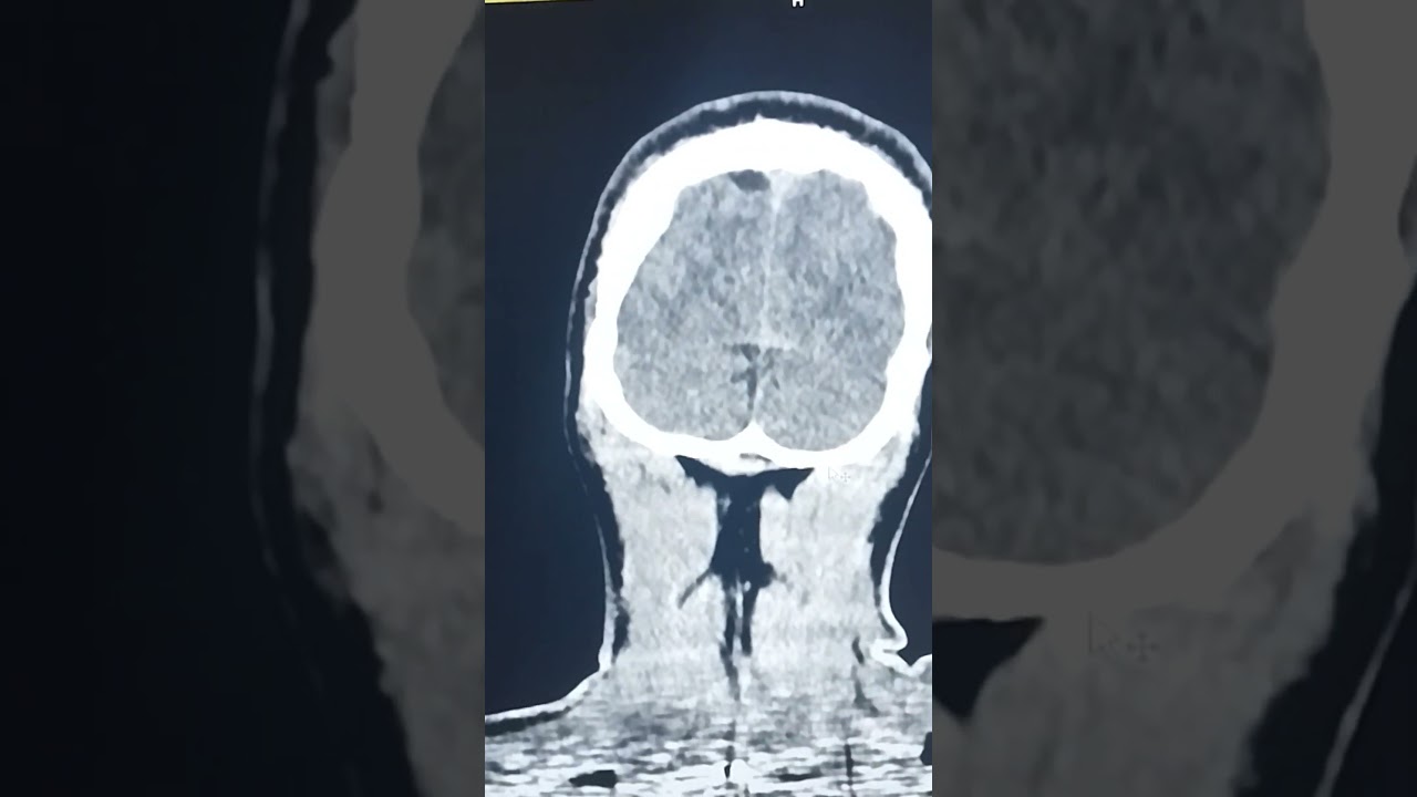 what is EDH, DSF and hemorrhagic contusion?