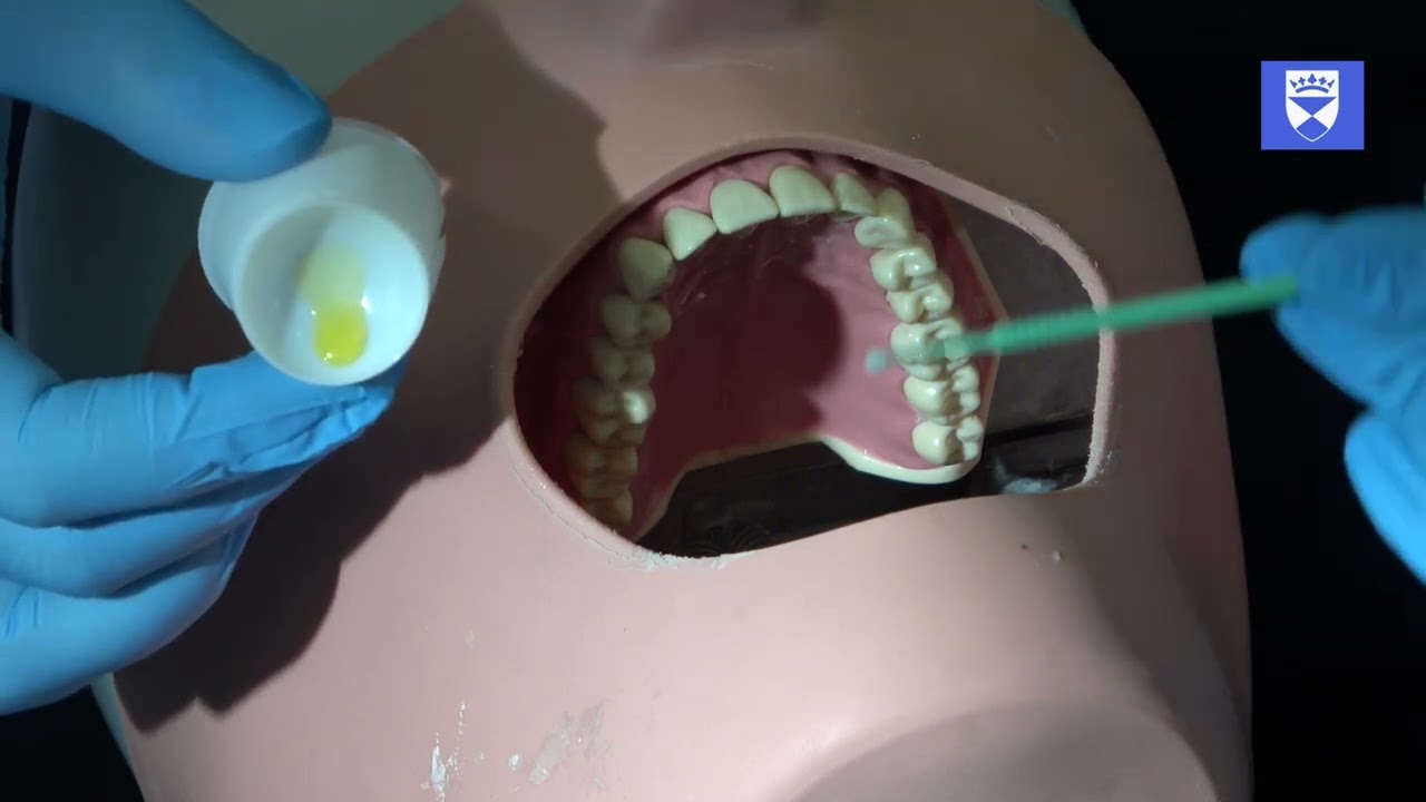 Traumatic dental injury: Splint placement