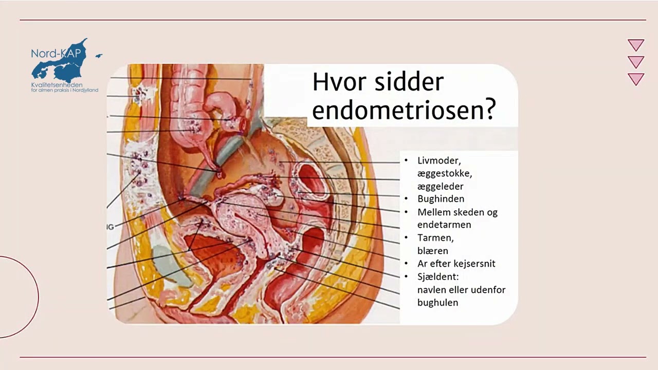Webinar: Dysmenoré og mistanke om endometriose