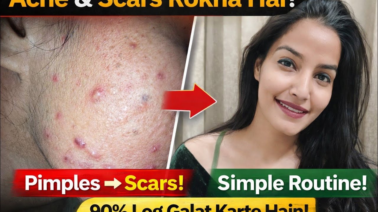 Acne & Scars Rokna Hai? Acne & Scars Stop Guide