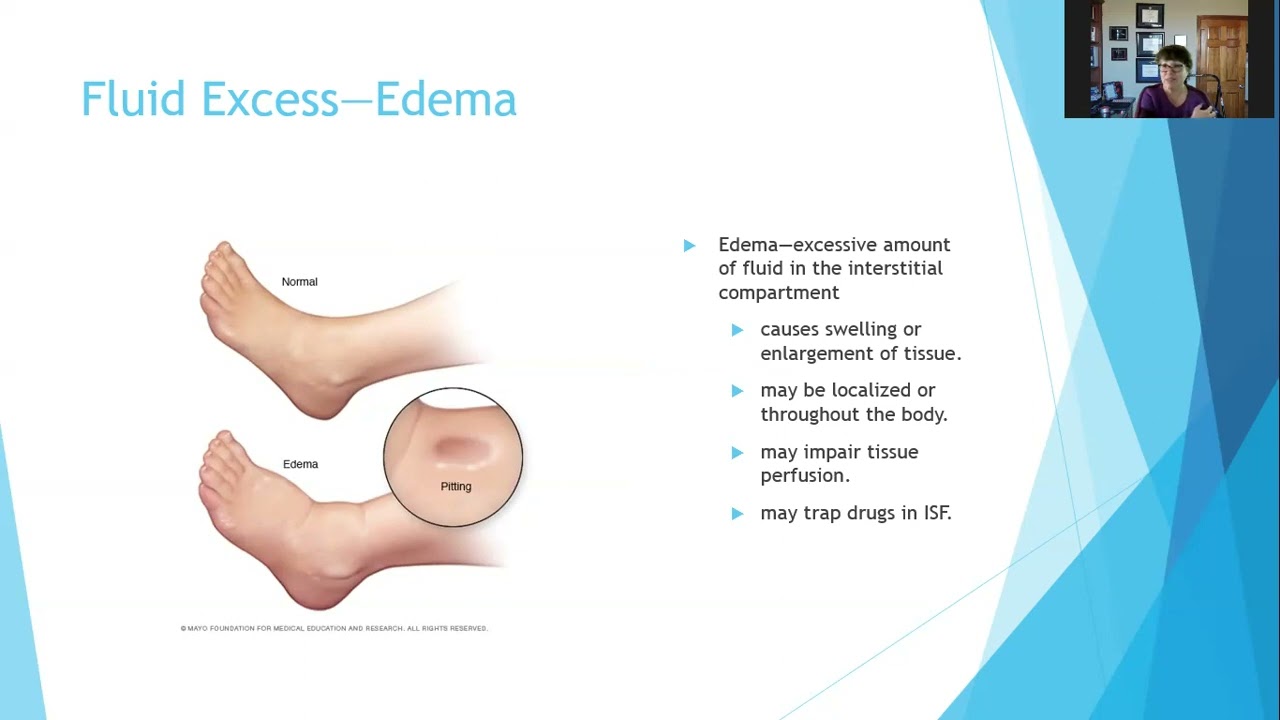 Chapter 2 001 Fluid Imbalance   Edema