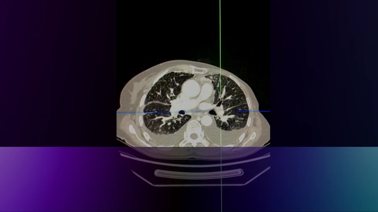 CT assessment - evaluating pulmonary lymphangitis carcinomatosis