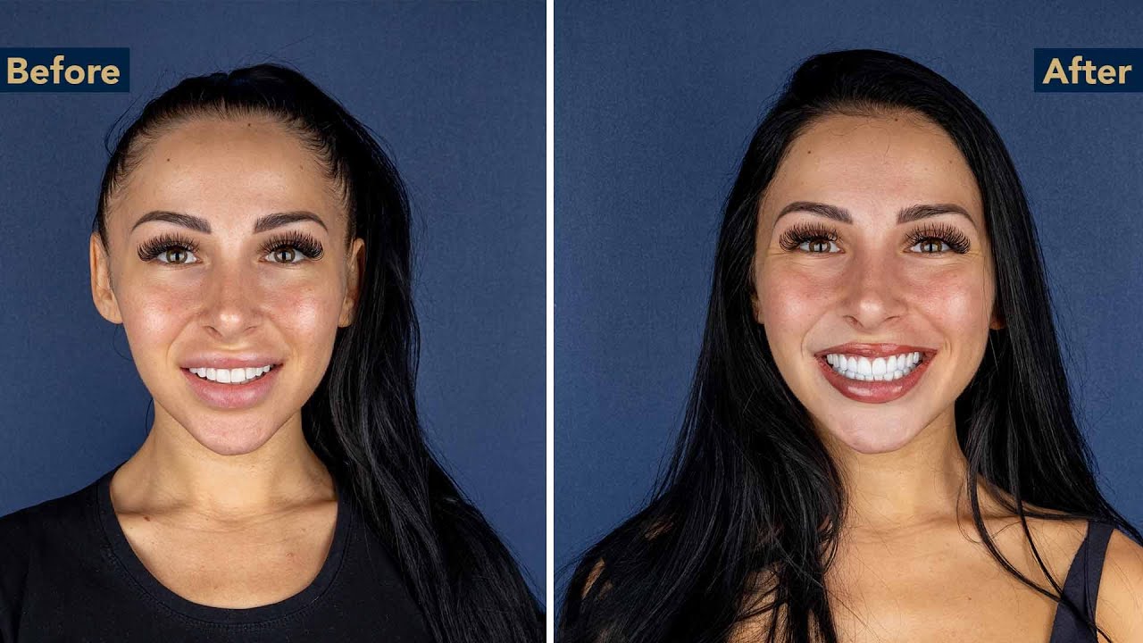 Veneers, Emax, Zircon Crowns & More | Timea’s Smile Journey