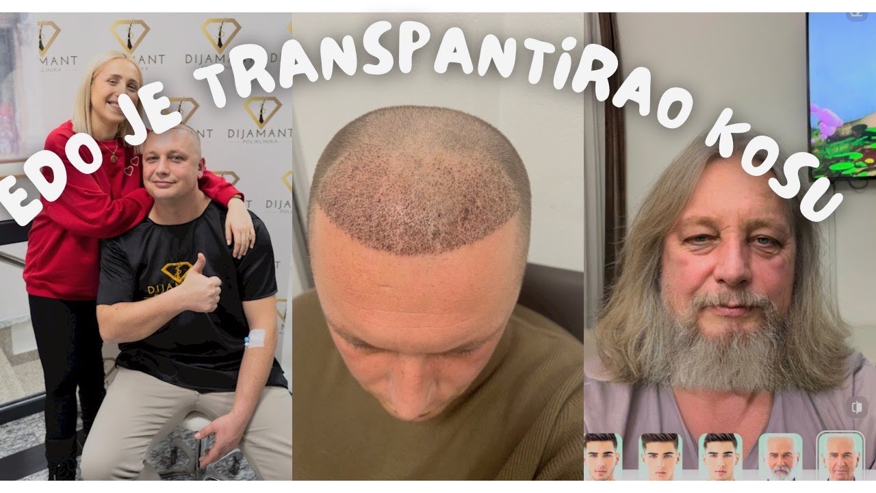 Edo je transplantirao kosu | Sve što ste htjeli znati | Ilda Humić
