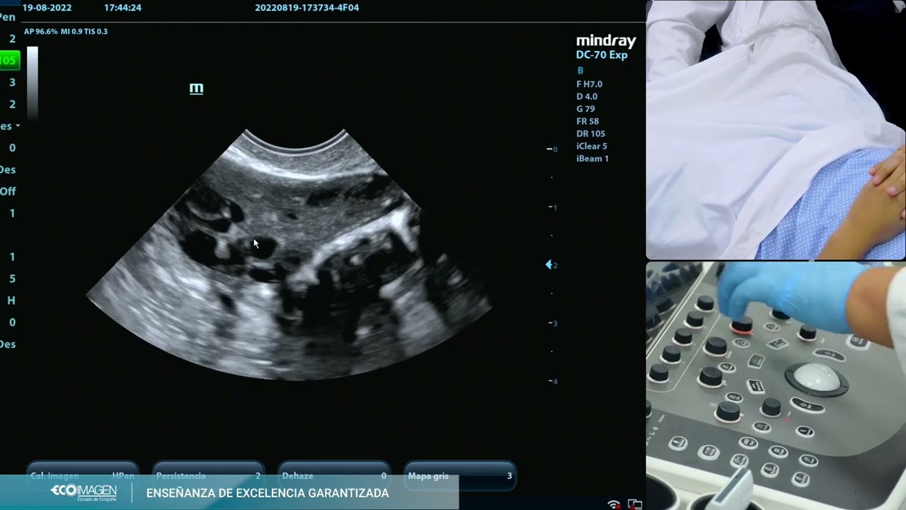 COMO DIAGNOSTICAR EL OVARIO POLIQUISTICO. DE UNA FORMA DIFERENTE