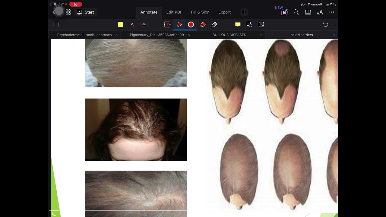 Dermatology lec 16 part 2( Hair disorders)